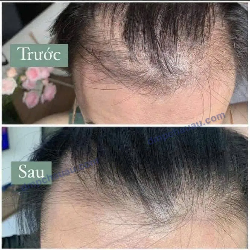 xit-moc-toc-minoxidil-bailleul